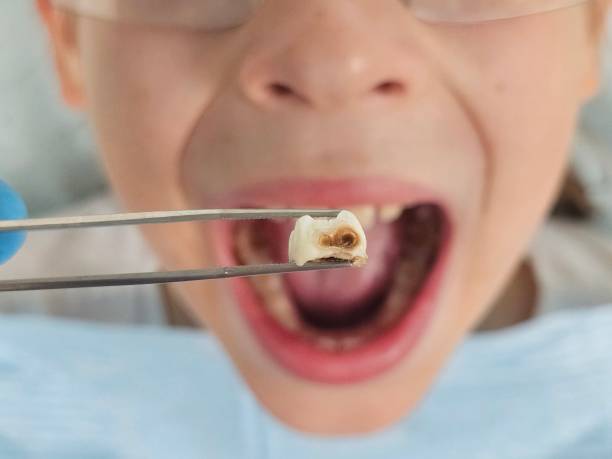 Best Urgent Care for Lost Fillings or Crowns in Webster, FL