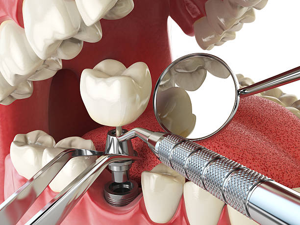 Best Emergency Tooth Extraction in Webster, FL